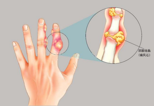 痛风新药！推进全球3期临床，填补治疗空白