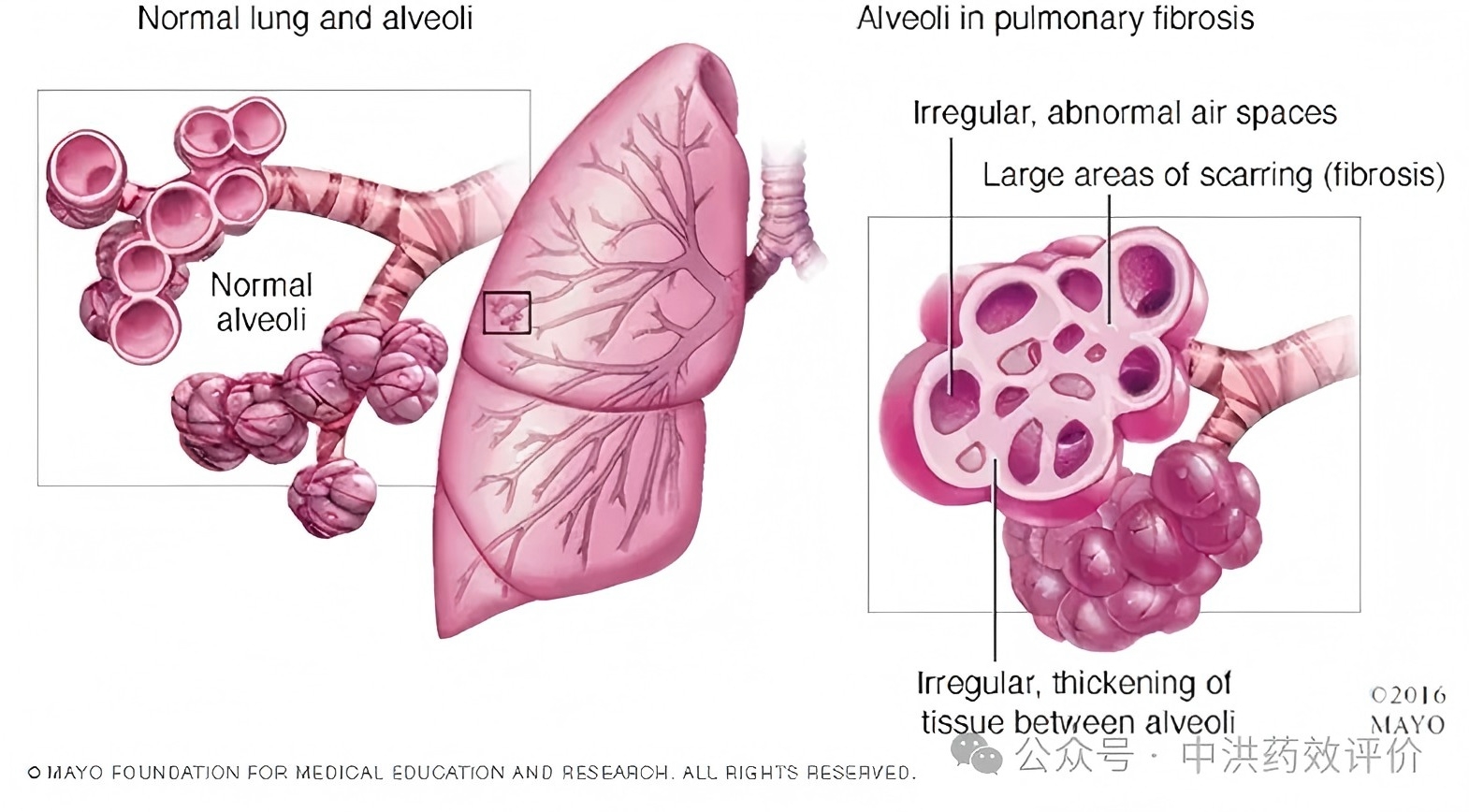 十余年僵局打破:2025肺纤维化3大创新突破