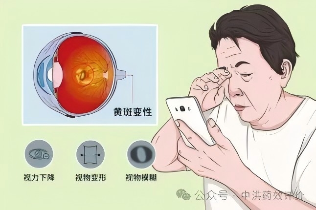 视网膜黄斑变性模型 | 从针头到滴剂：眼科给药的无创革命，改写患者治疗体验