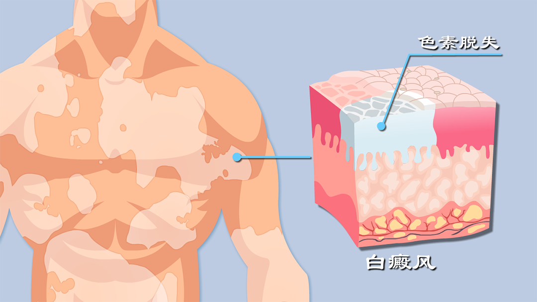 首款且唯一！白癜风重磅创新药国内获批上市 | 附白癜风模型介绍