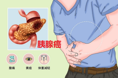 癌王有望终结:胰腺癌新靶点+新药联合治疗