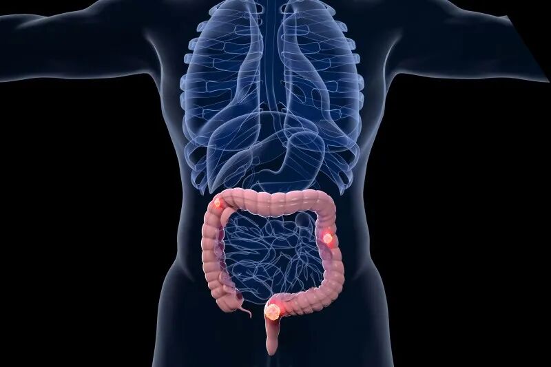 每年90万人死亡!从“不可治愈”到临床完全缓解,结直肠癌治疗迎来范式革命